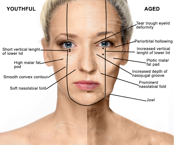 Aging face | Facelift surgery | Face-lift surgery